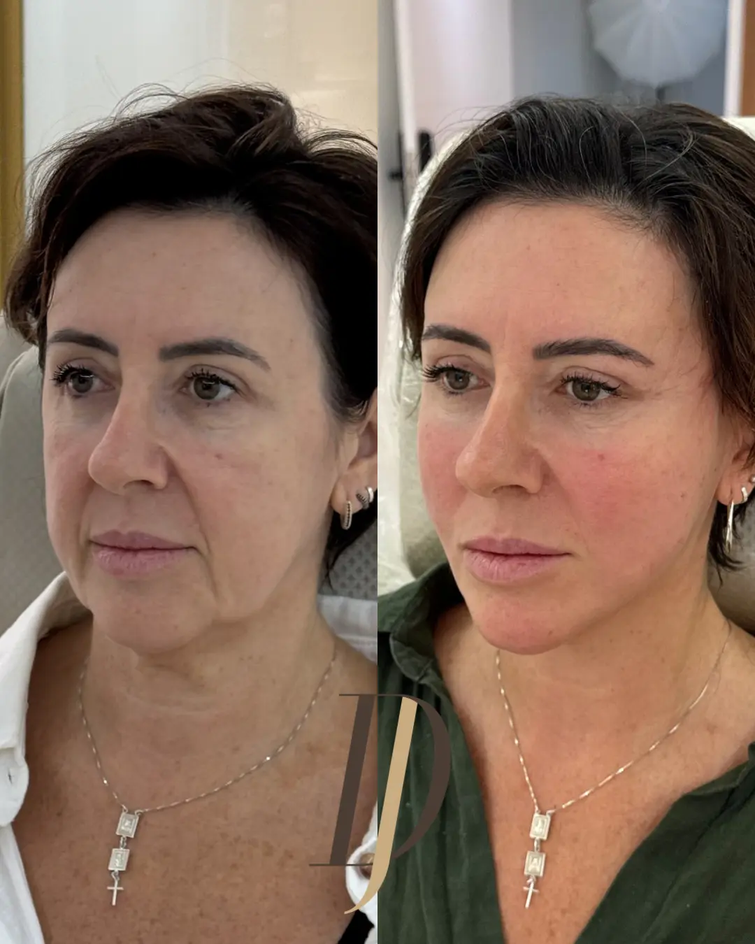 Resultado de rejuvenescimento facial: antes e depois 3