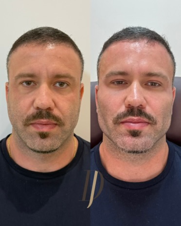 Resultado de rejuvenescimento facial: antes e depois 1