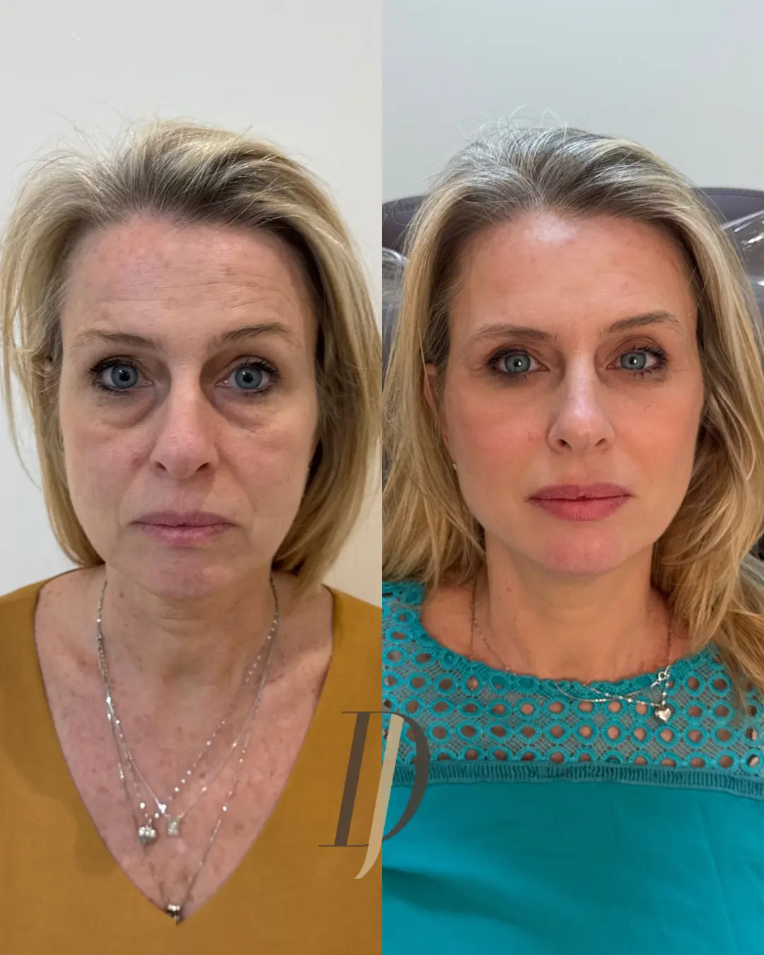 Resultado de rejuvenescimento facial: antes e depois 2